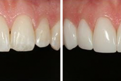 composite-bonding-before-and-after