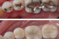 before-and-after-fillings-2