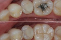 before-and-after-fillings