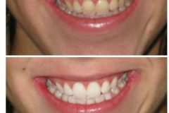 Before And After Teeth Whitening