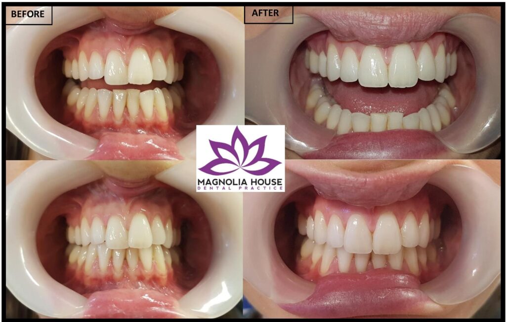 Before and after Invisalign Havant
