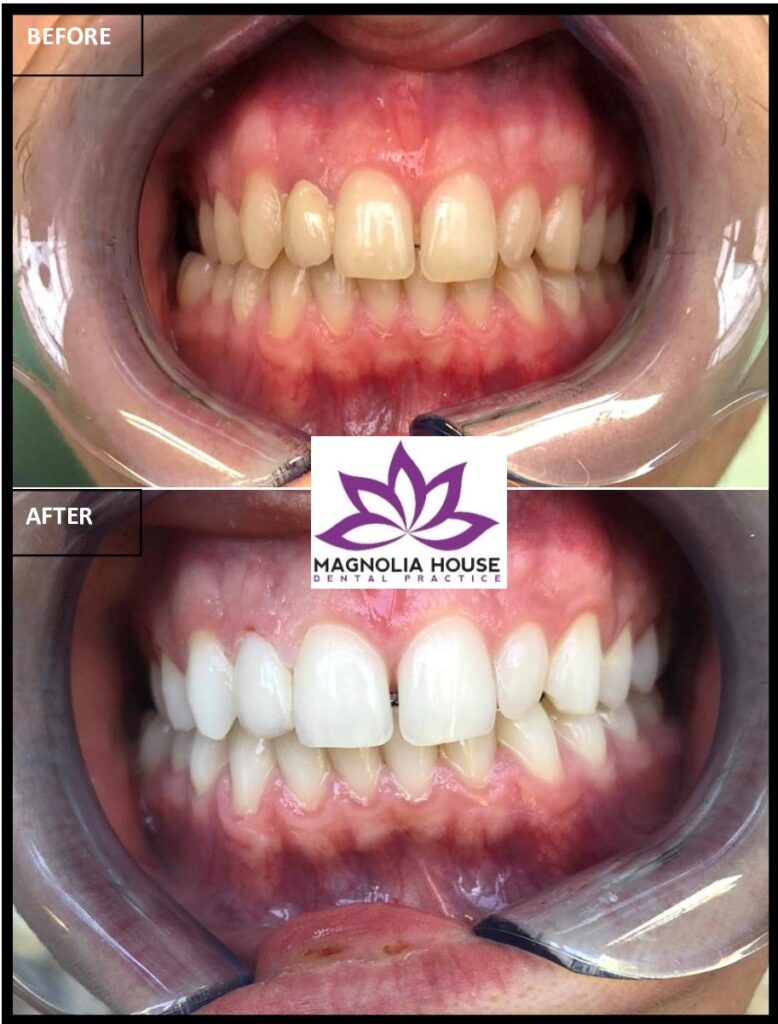 teeth-whitening-before-after-havant