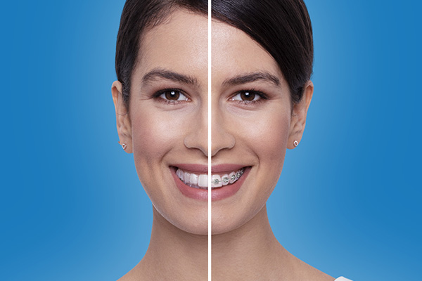 Invisalign vs Fixed braces havant